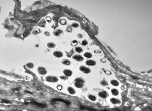 M,68y. | epidermis … otitis externa (mycotic v.s.) M,68y. | epidermis … otitis externa (mycotic v.s.)